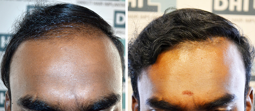 DHI before & after hair transplant results